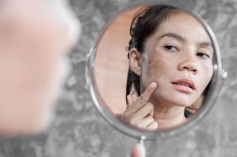 Da bị nám sạm, thâm mụn đều có thể tiêm meso để phục hồi da
