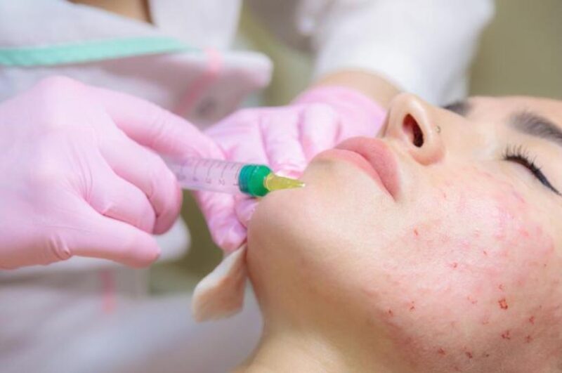 Meso trị mụn là phương pháp làm đẹp mang lại hiệu quả nhanh chóng